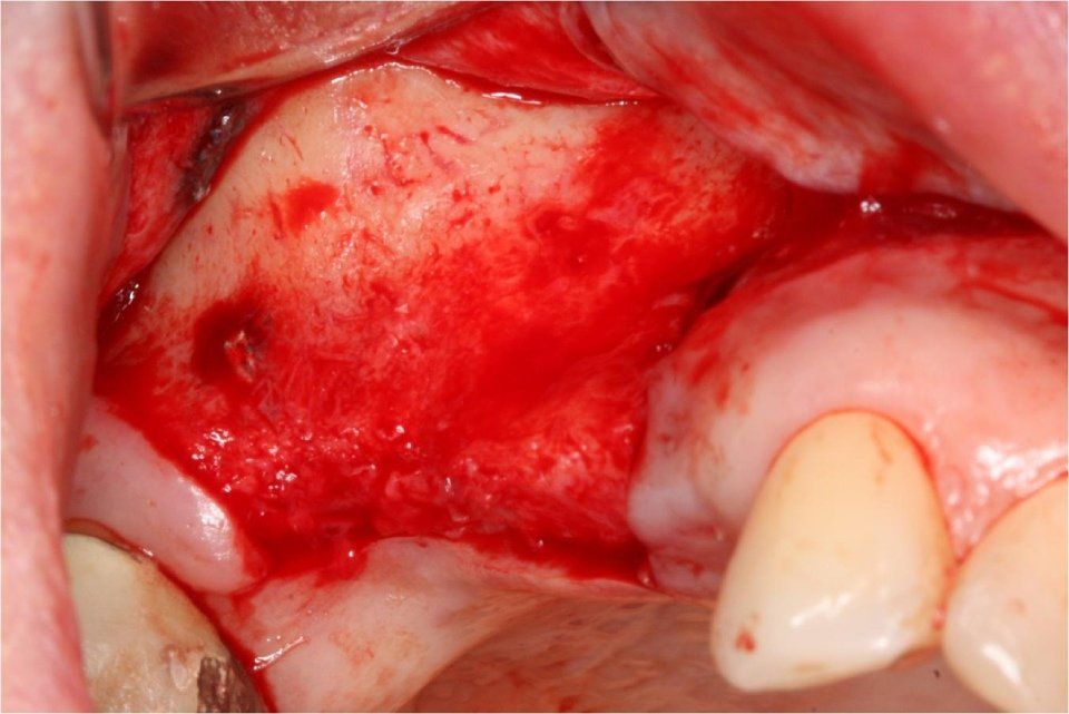 Vista chirurgica di un'area sanguinante della mascella superiore con osso esposto, probabilmente durante una procedura odontoiatrica; dente visibile.