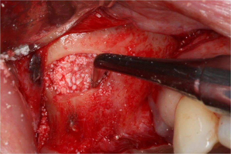 Immagine chirurgica di tessuto gengivale e osso aperti con trapano dentistico, probabilmente un intervento di rialzo del seno mascellare. Rosso e bianco.
