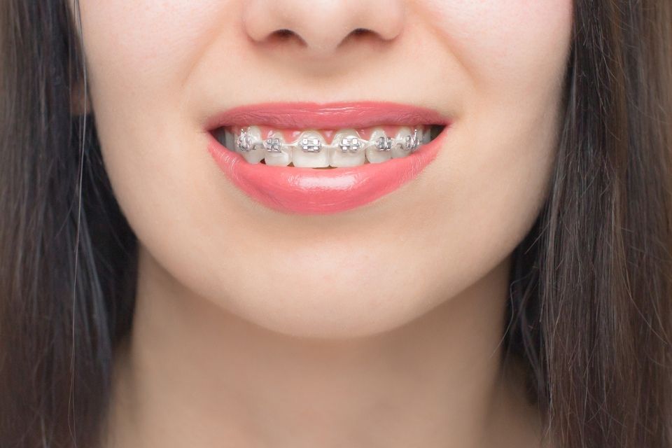 Primo piano di una persona sorridente, che mostra i denti con l'apparecchio metallico e il rossetto rosa.