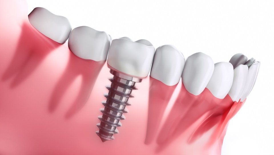 Impianto dentale con una vite inserita nell'osso mascellare, circondata dalle gengive e dai denti adiacenti.