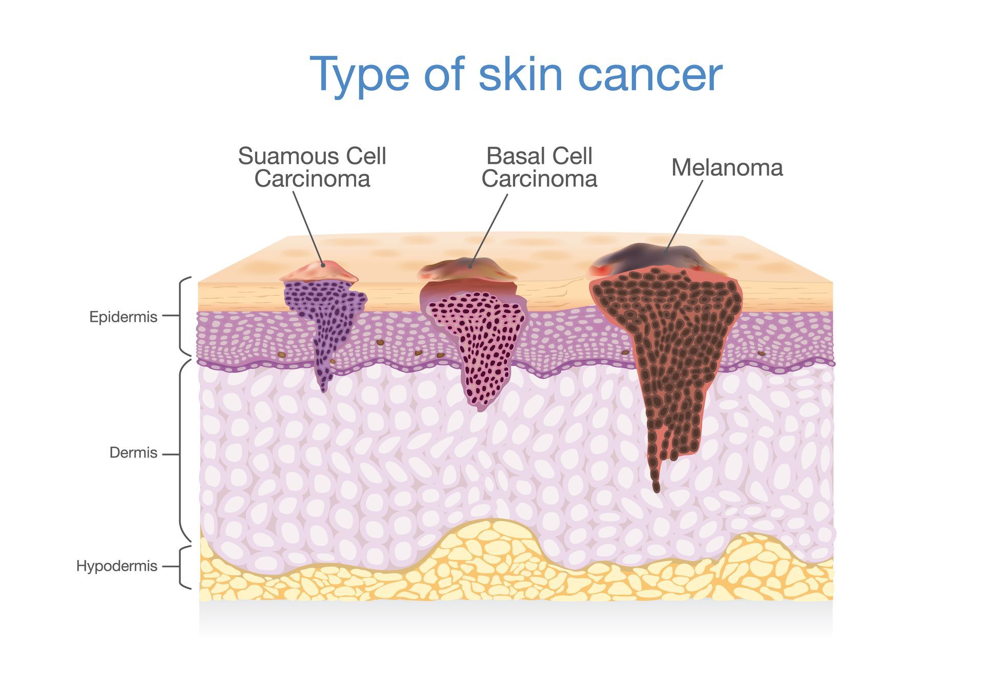 Diagram showing three types of skin cancer: squamous cell, basal cell, and melanoma.