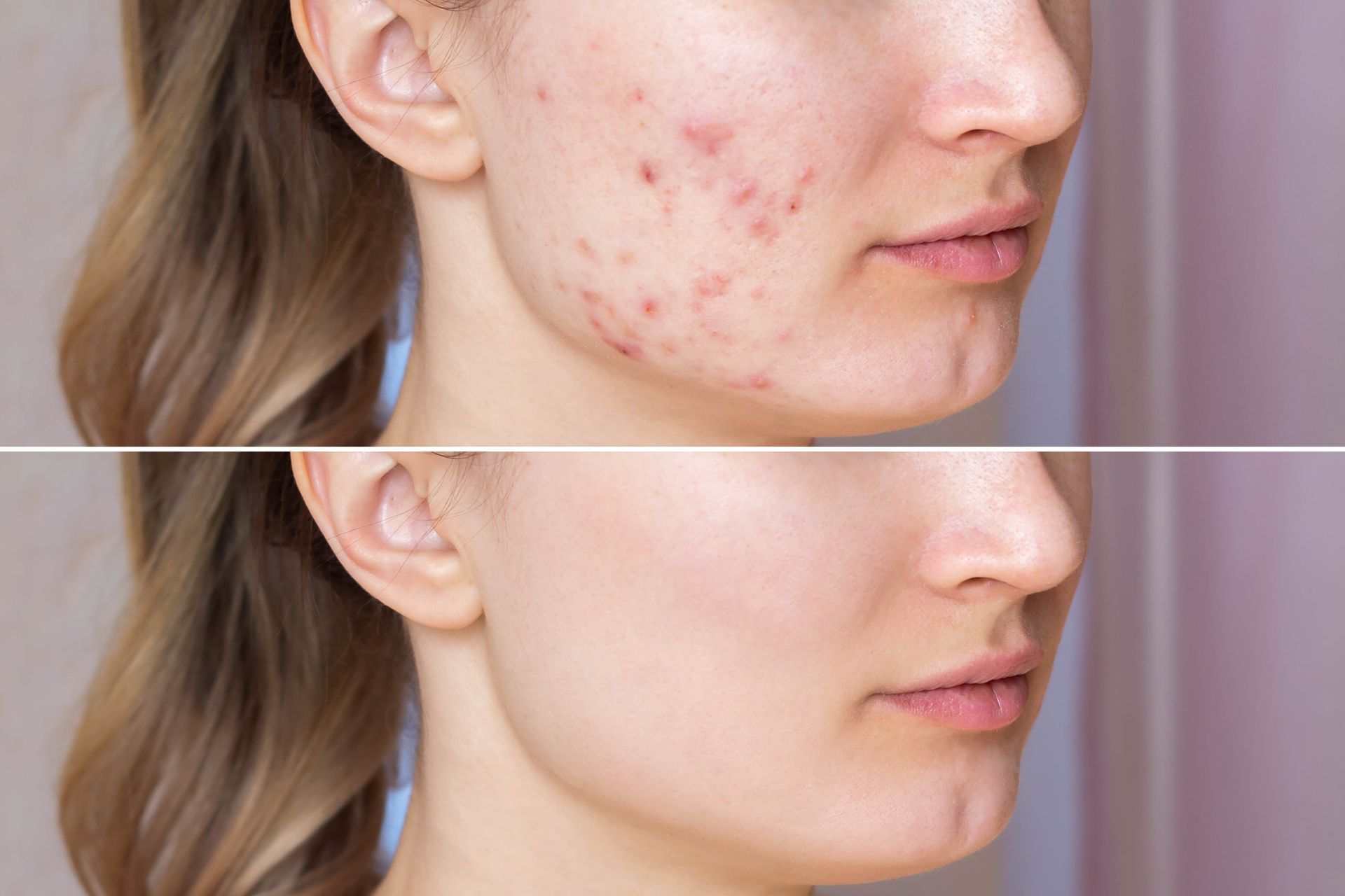 Before-and-after side profile of a cheek with acne, showing clearer skin in the lower image