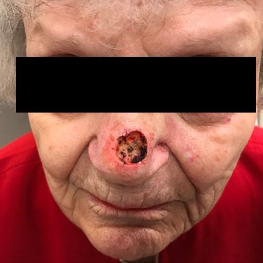 real patient before and after reconstructive surgery after mohs in phoenix arizona
