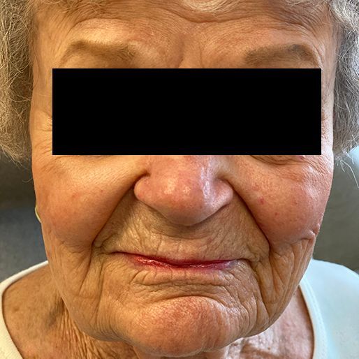 Mohs Surgery - Case 1 After