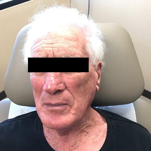 Mohs Surgery - Case 14 After