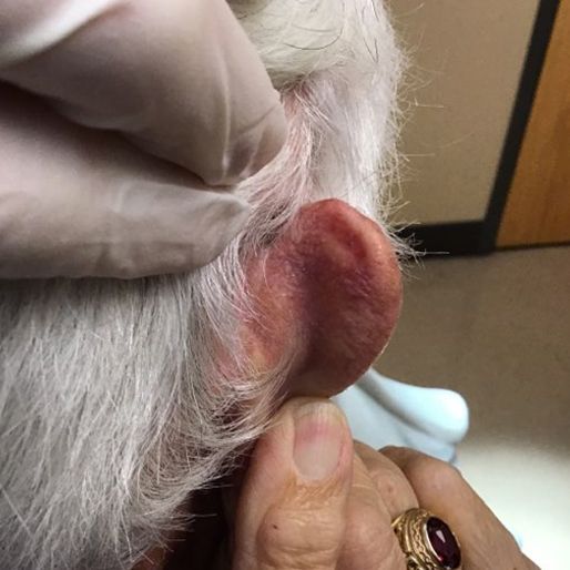 Mohs Surgery - Case 30 After