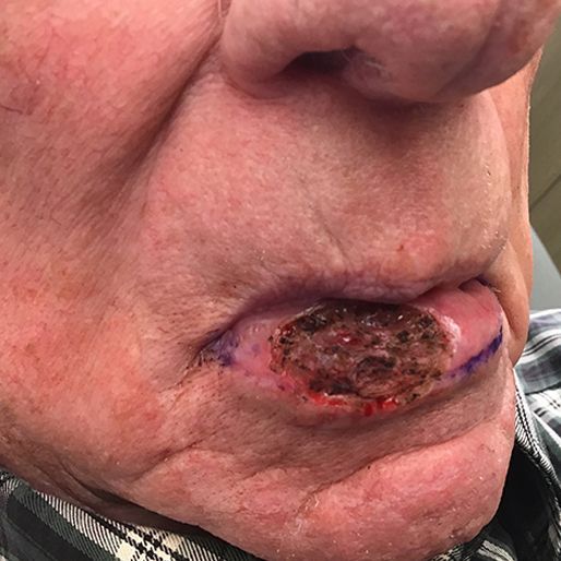 Mohs Surgery - Case 6 before