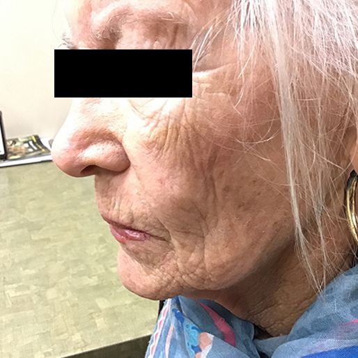 Mohs Surgery - Case 7 After