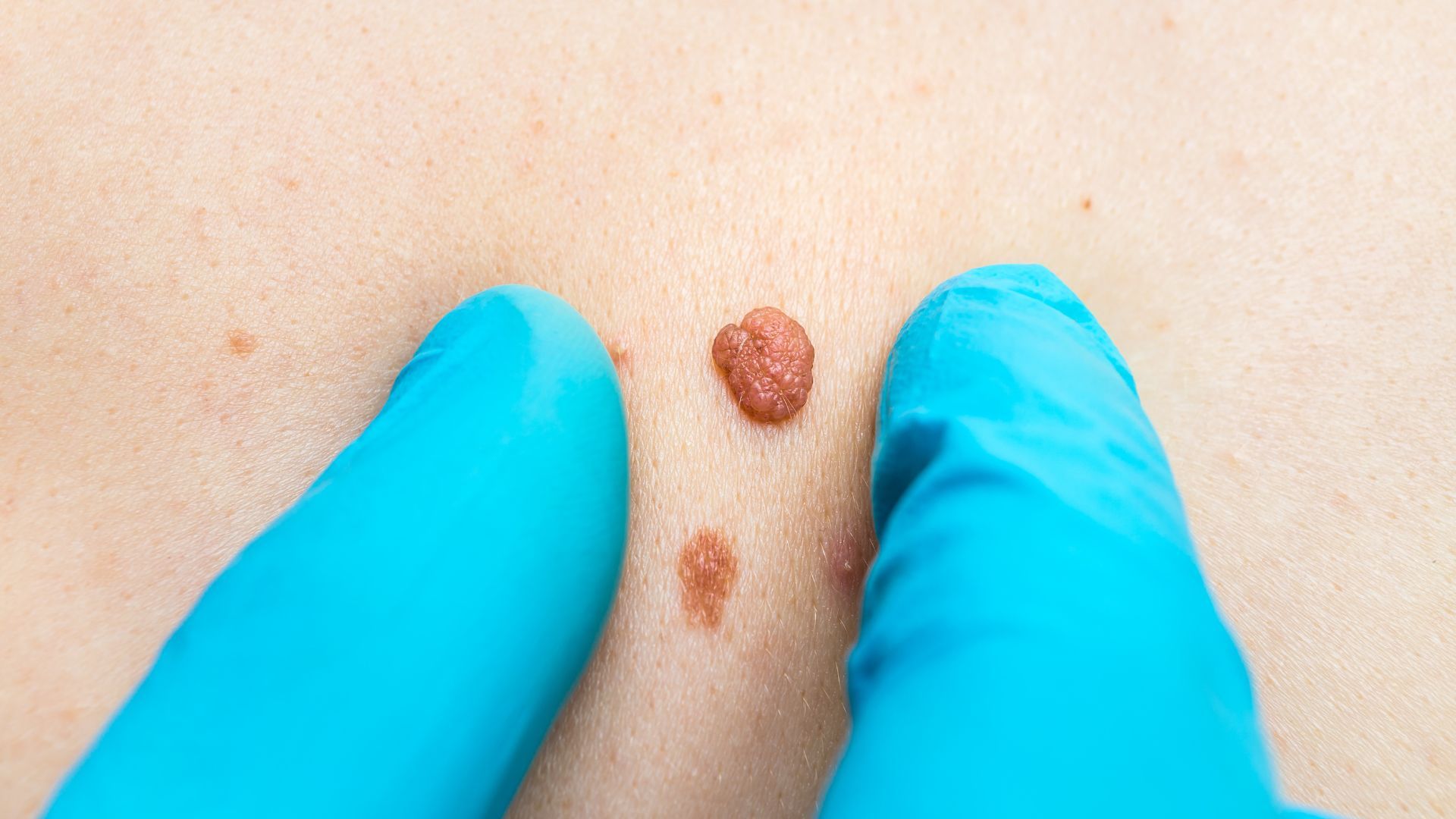 Gloved hands examining two small raised skin lesions on a person’s torso