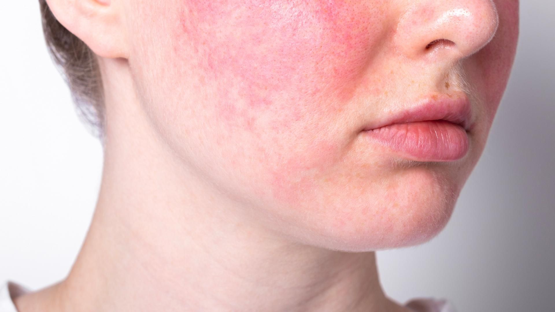 Close-up of a face with red, irritated skin on the cheek and jawline