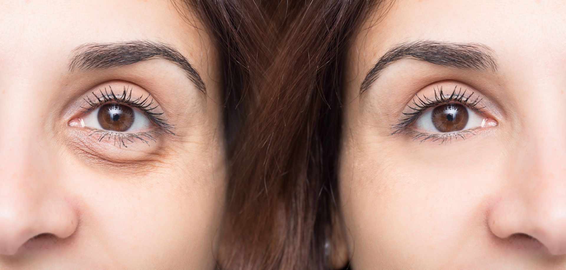 Close-up of two eyes and eyebrows, one with visible under-eye circles, shown side by side for comparison