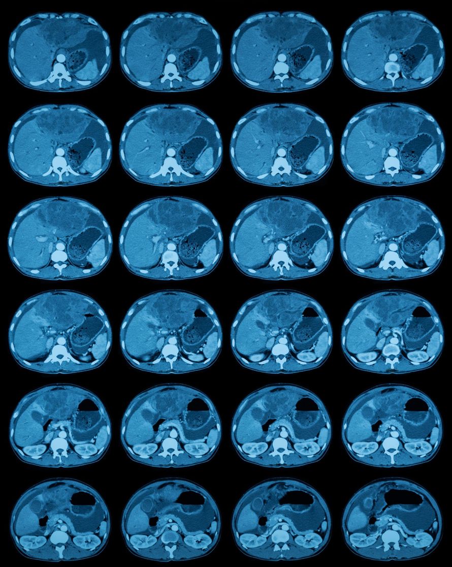 CT scan of abdomen, series of cross-sectional views. Internal organs show in shades of blue.