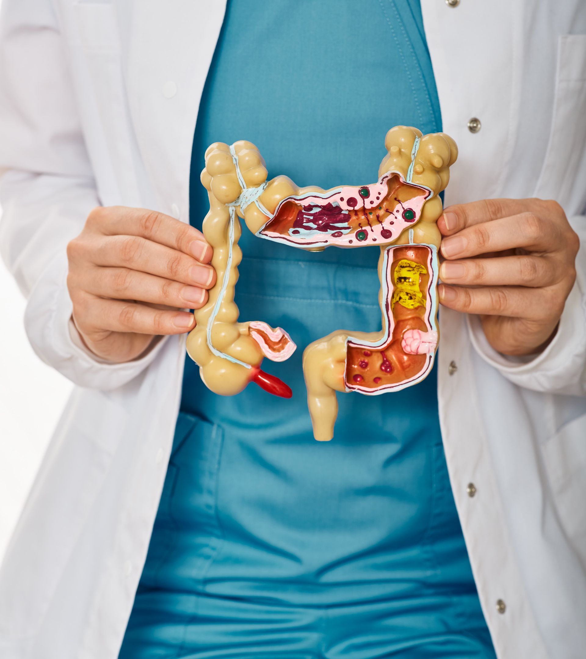 Doctor holding a colon model displaying areas of illness.