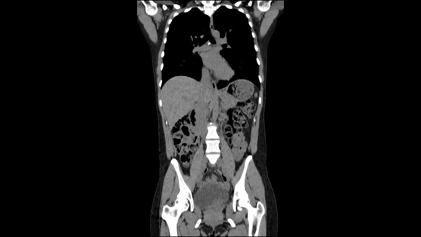 Coronal CT scan of human torso, showing internal organs: lungs, liver, intestines, and pelvic bones.