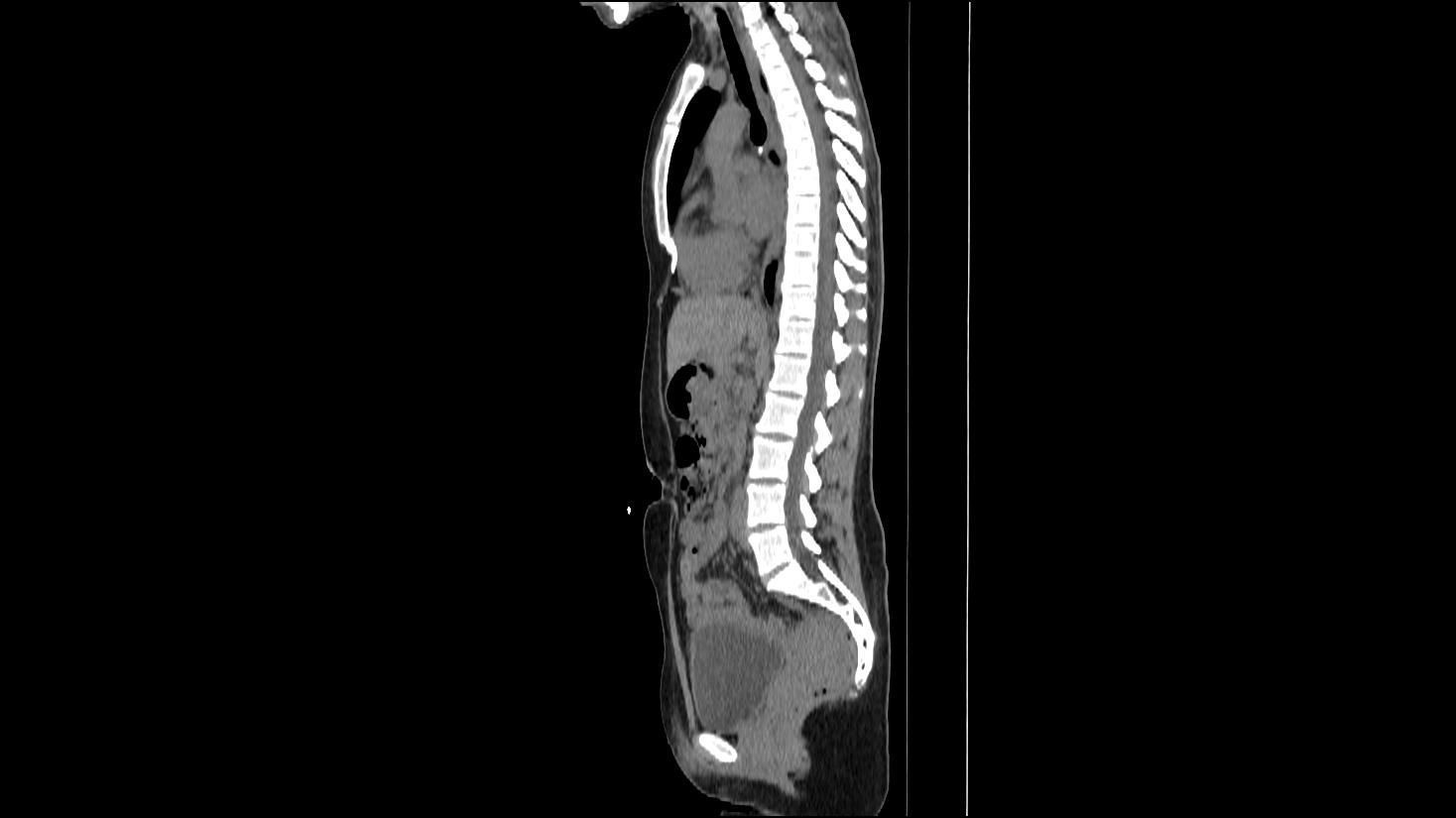 Sagittal CT scan of a human torso, showing spine, internal organs, and potential abnormalities.