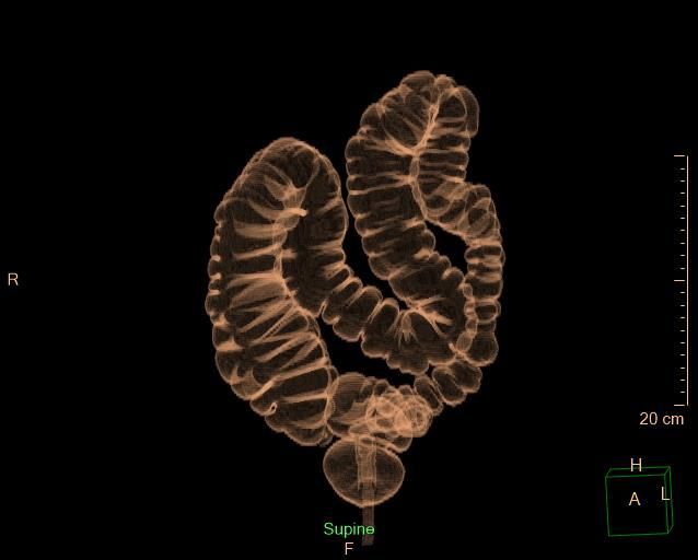 3D CT scan rendering of the human intestines. The intestines are brown and have a ridged appearance, showing their folds.