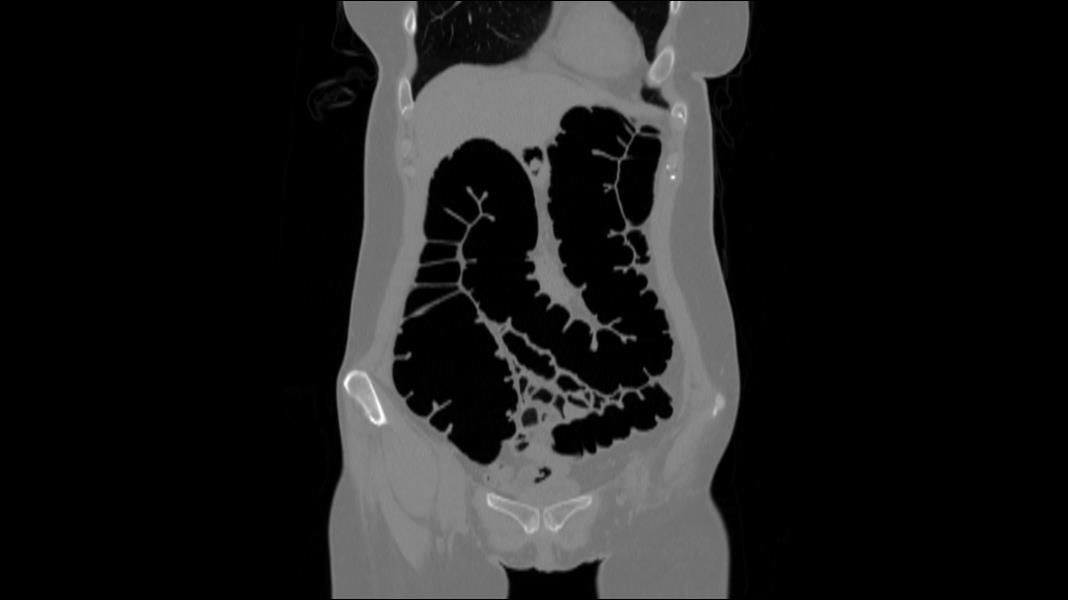 Medical professional holding a model of a colon with various conditions, including inflammation and polyps.