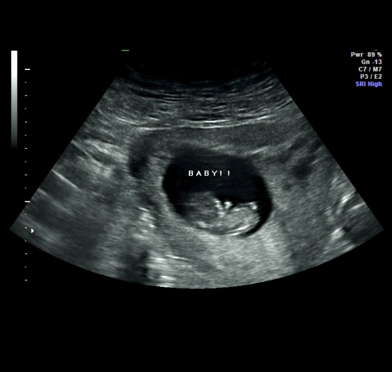 Ultrasound scan showing a gestational sac with a small embryo labeled “BABY II”