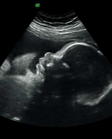 Ultrasound scan showing a fetus in profile inside the womb