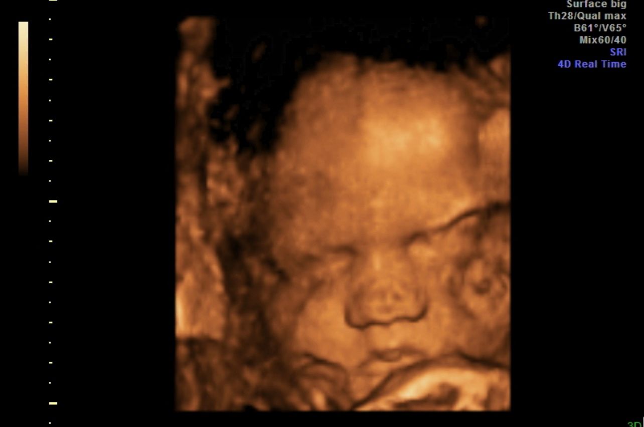 Ultrasound scan showing a fetus’s face in warm orange tones