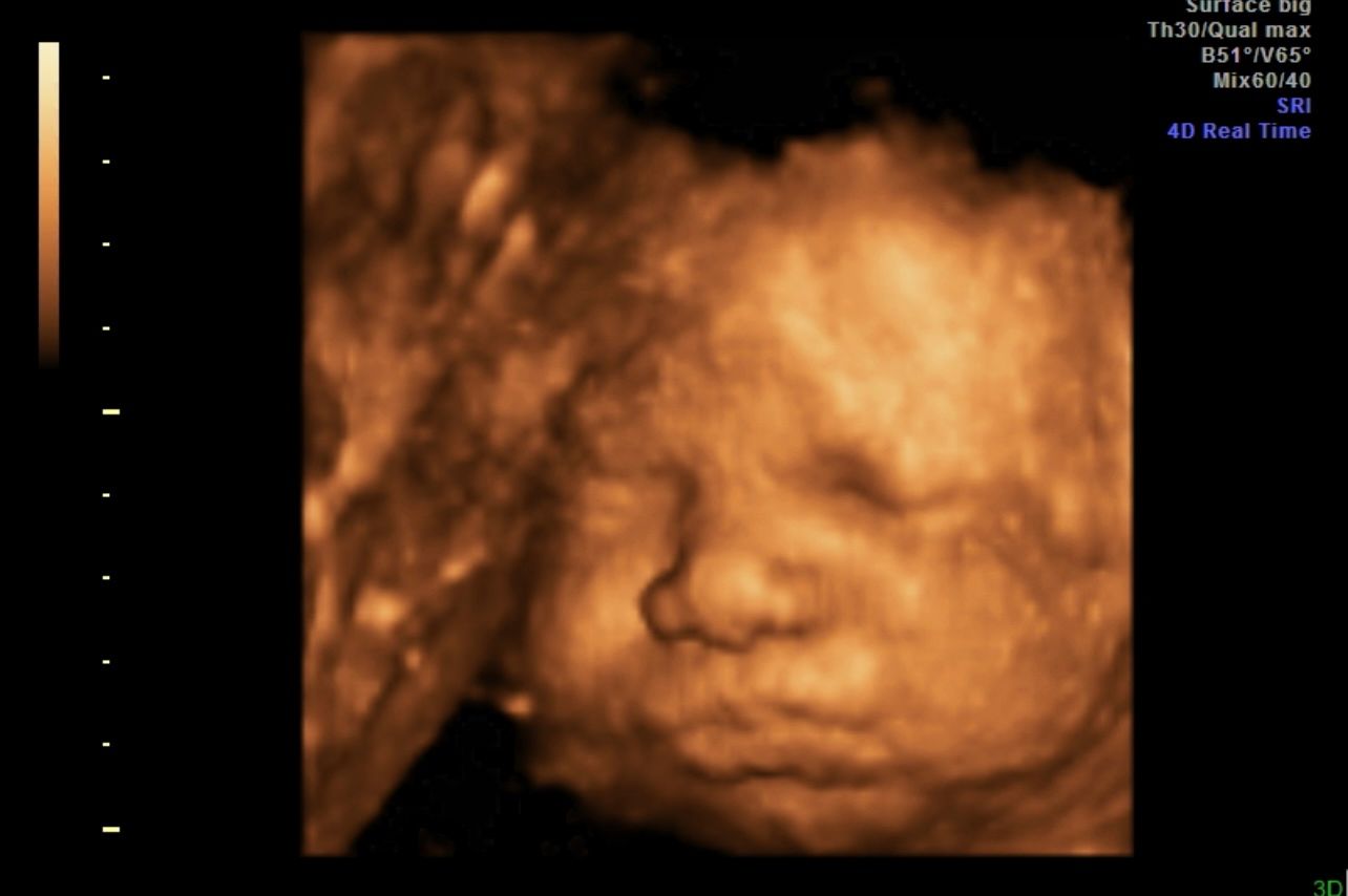3D ultrasound scan of a baby’s face in the womb, with soft sepia tones.