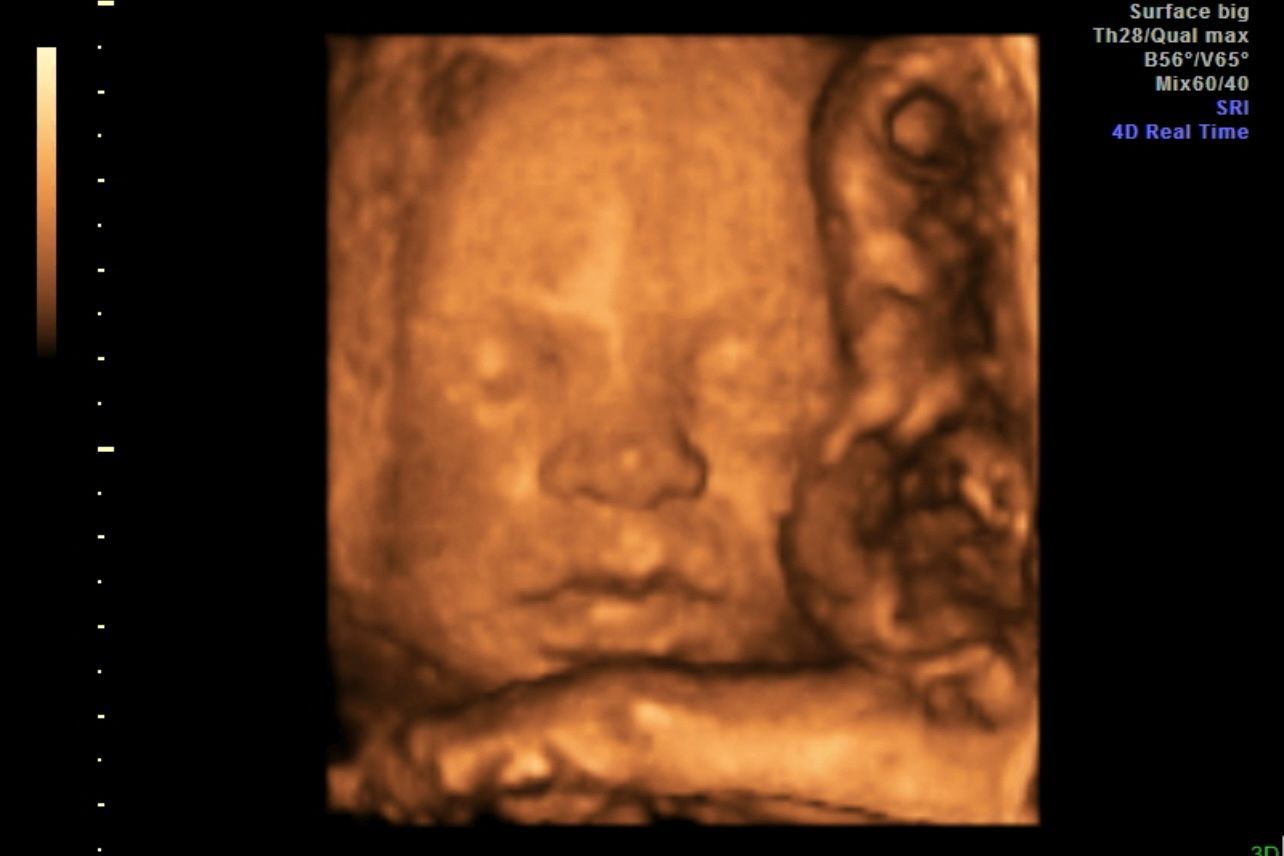 Sepia 3D ultrasound of a sleeping fetus with face and hand visible