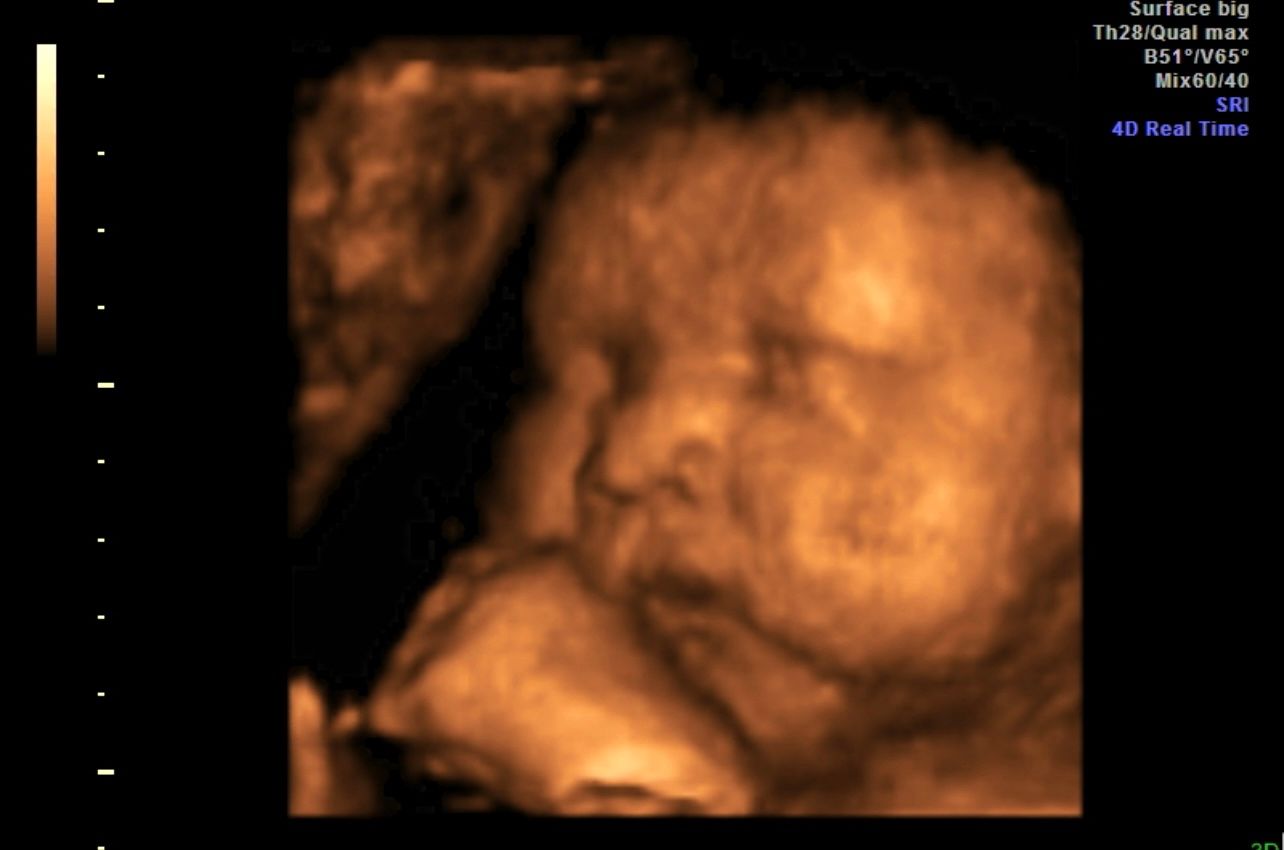 Sepia-toned ultrasound image of a fetus in profile, with measurement markers on the left.