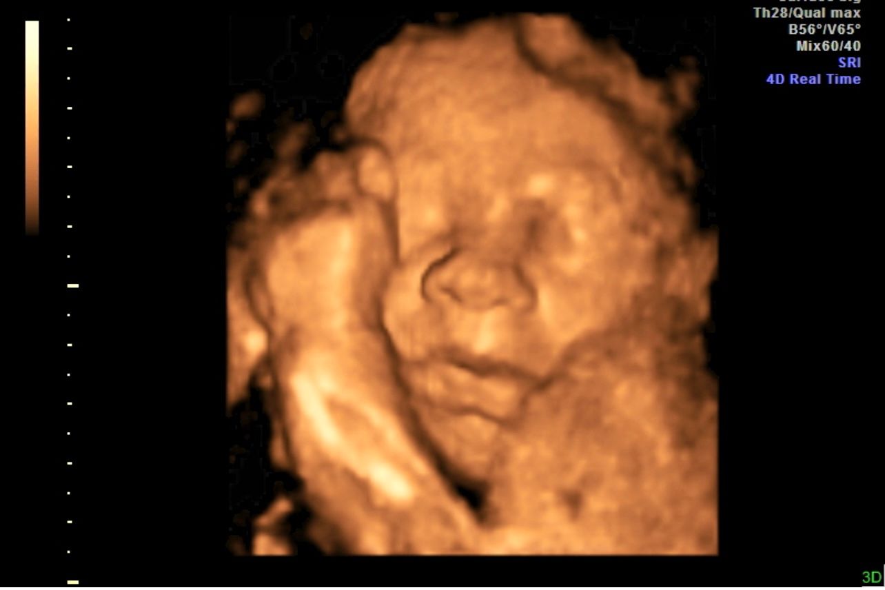 Ultrasound scan showing a fetus in the womb, rendered in sepia tones