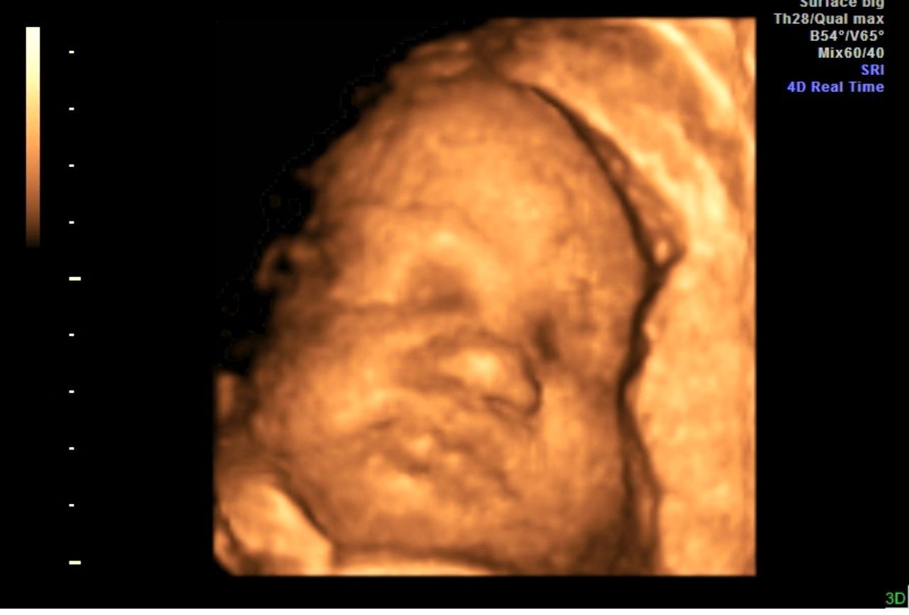 3D ultrasound of a sleeping fetus in the womb
