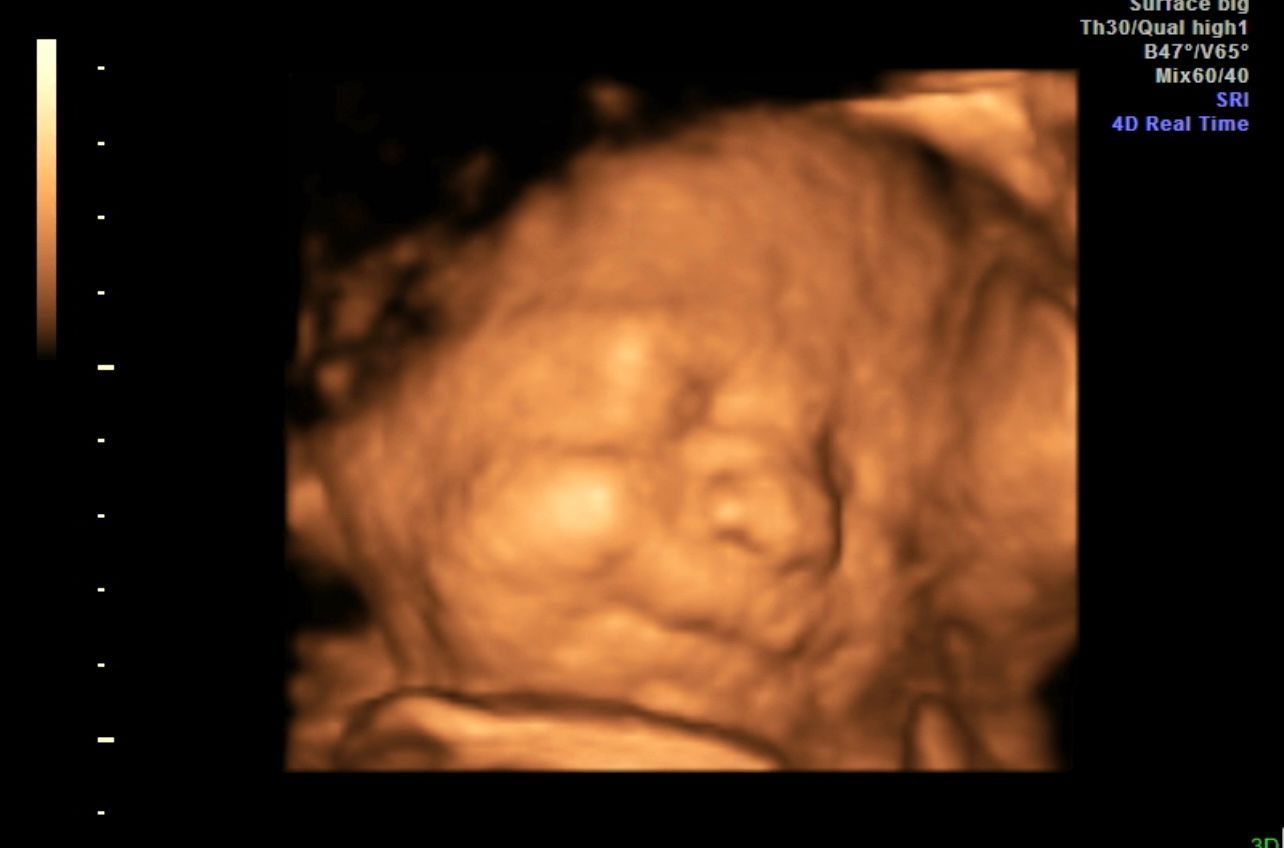 3D ultrasound of a fetus in warm orange tones, showing the baby’s face curled up in profile