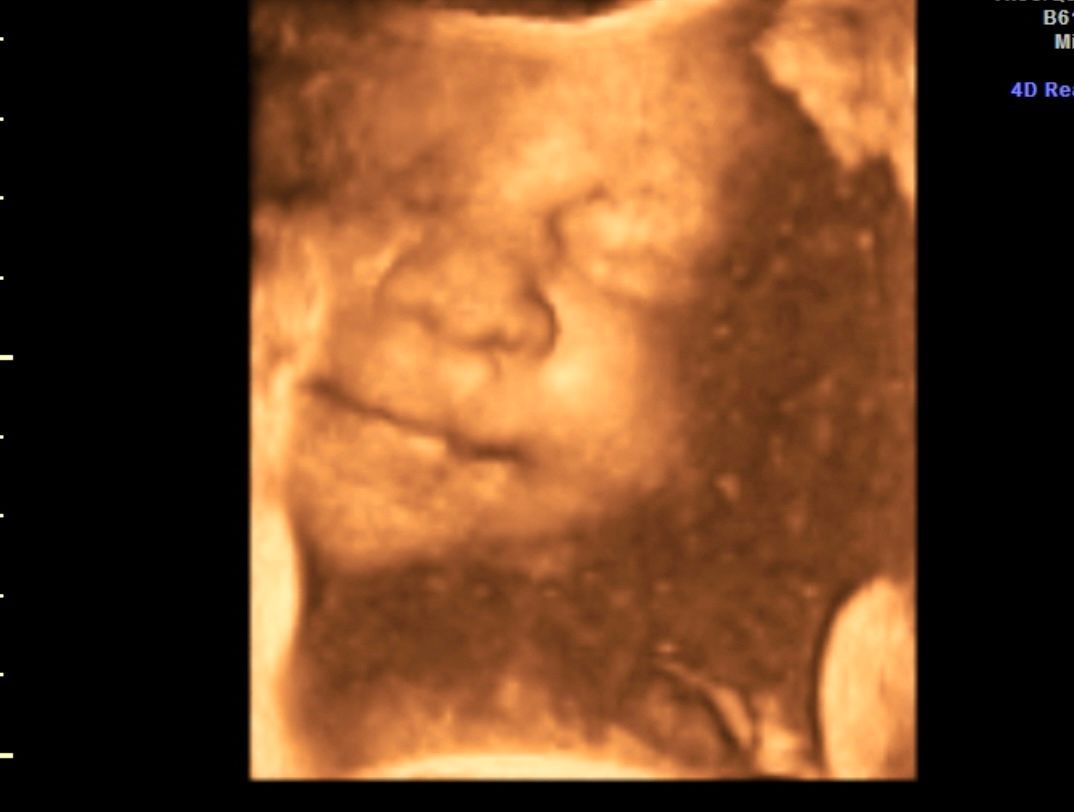 Sepia 3D ultrasound showing a fetus’s face in close-up, eyes closed and lips visible