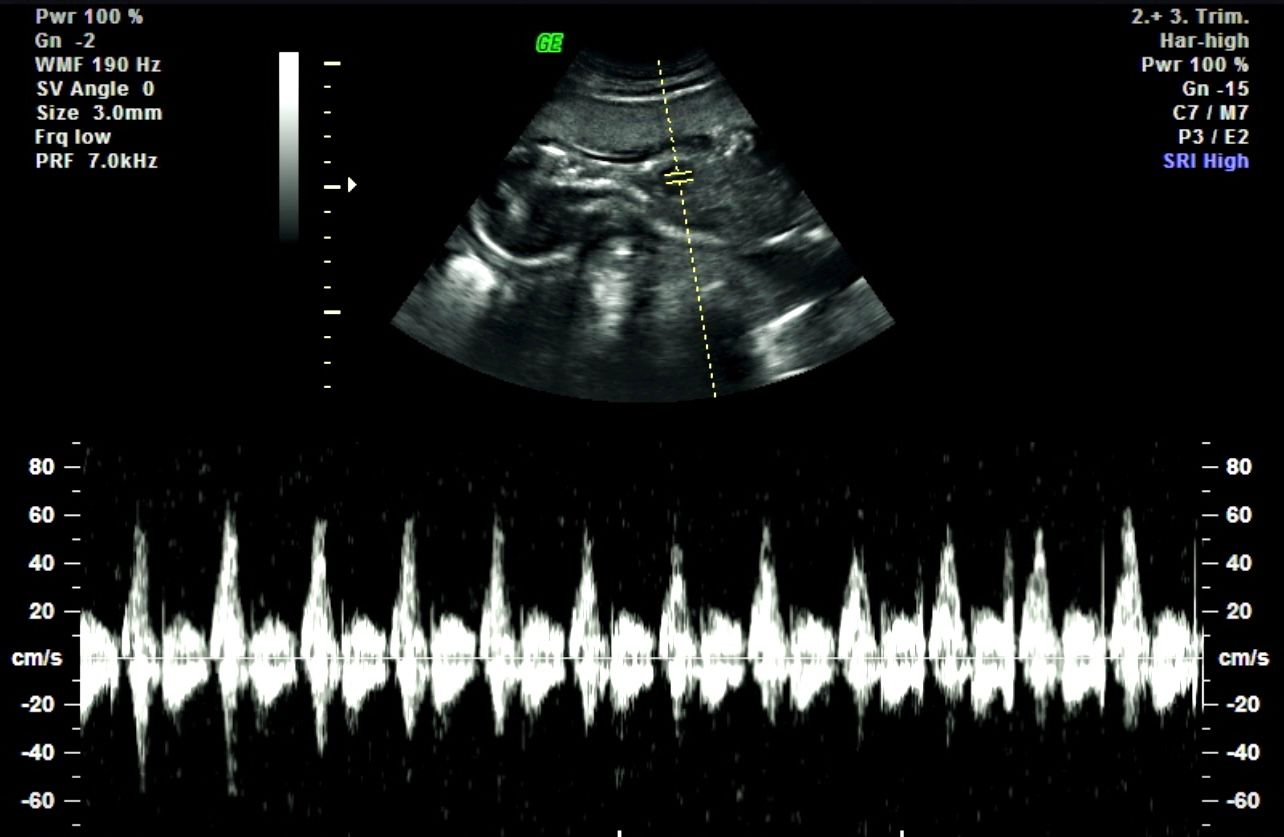 Ultrasound scan with Doppler waveform and measurement markers on a black background