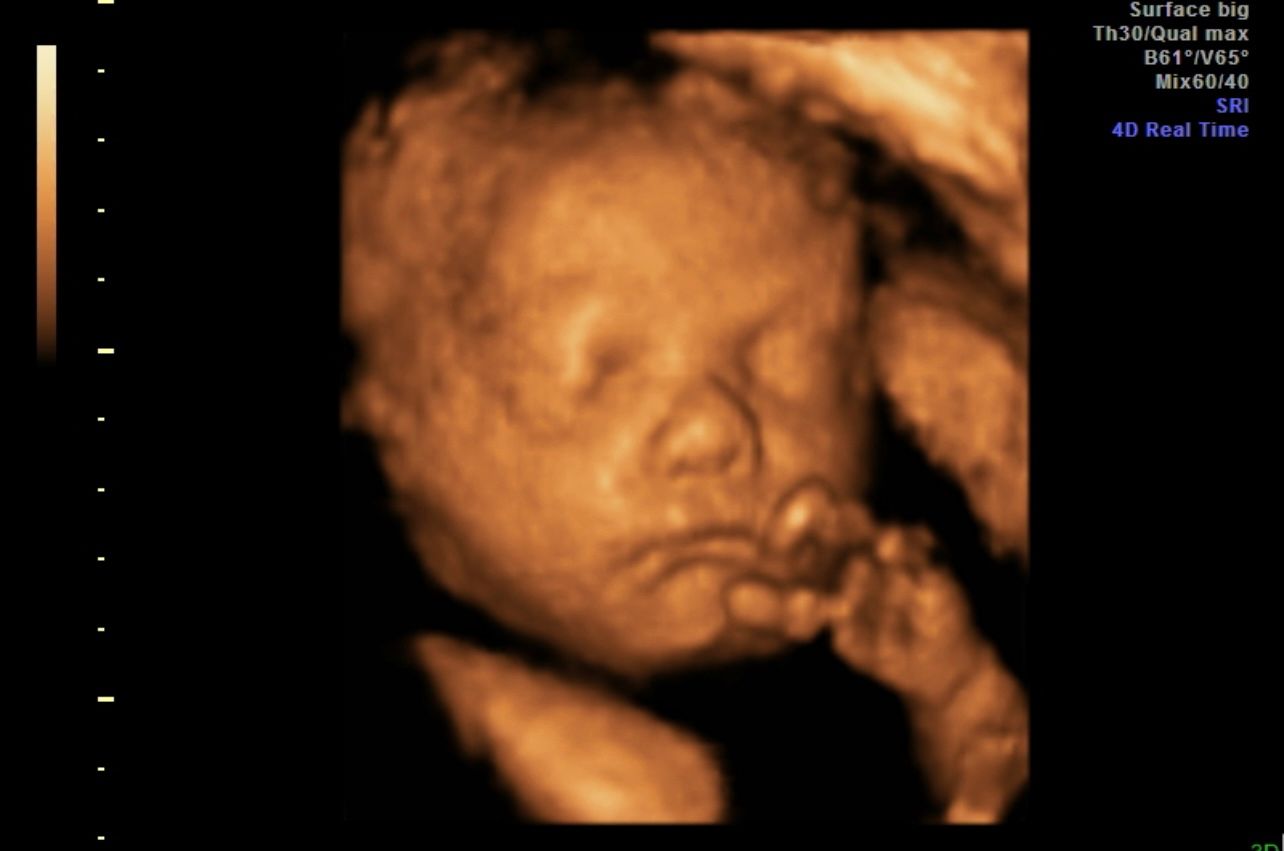 3D ultrasound of a fetus sleeping with hand near face, in warm orange tones
