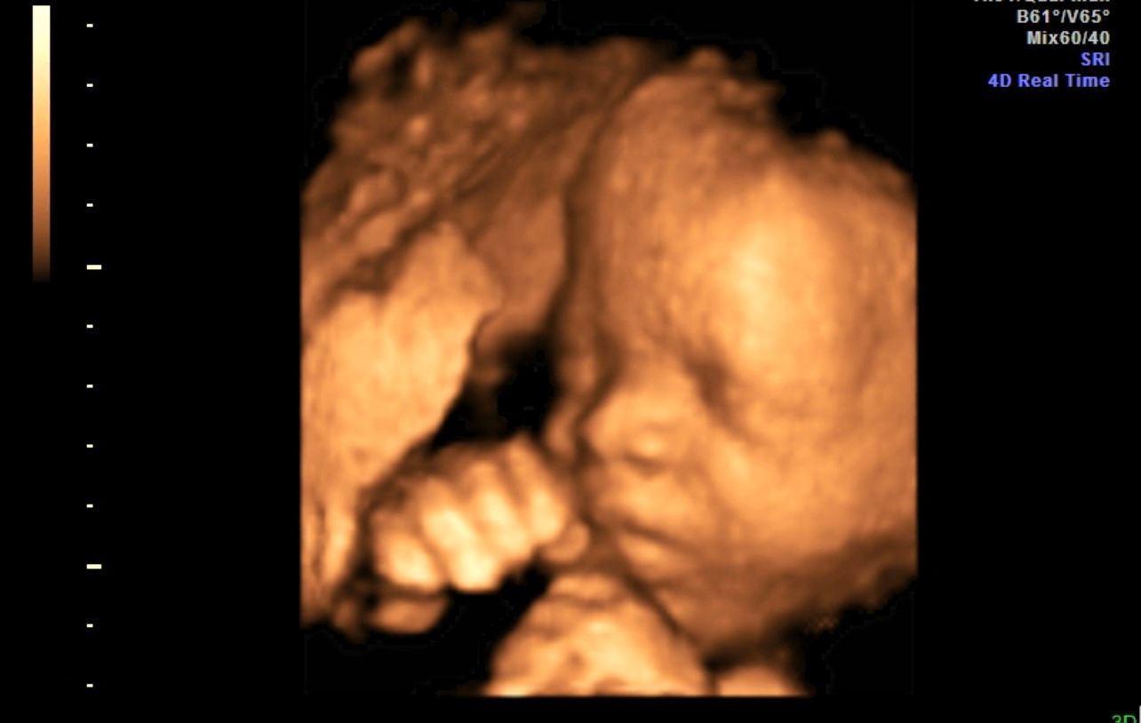 3D ultrasound image of a sleeping fetus, showing the face and hand in warm sepia tones