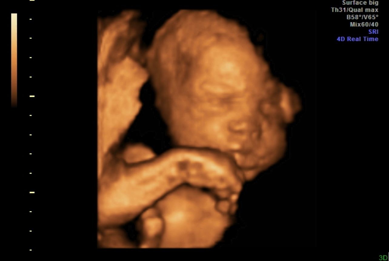 3D ultrasound of a sleeping fetus with a hand near its face