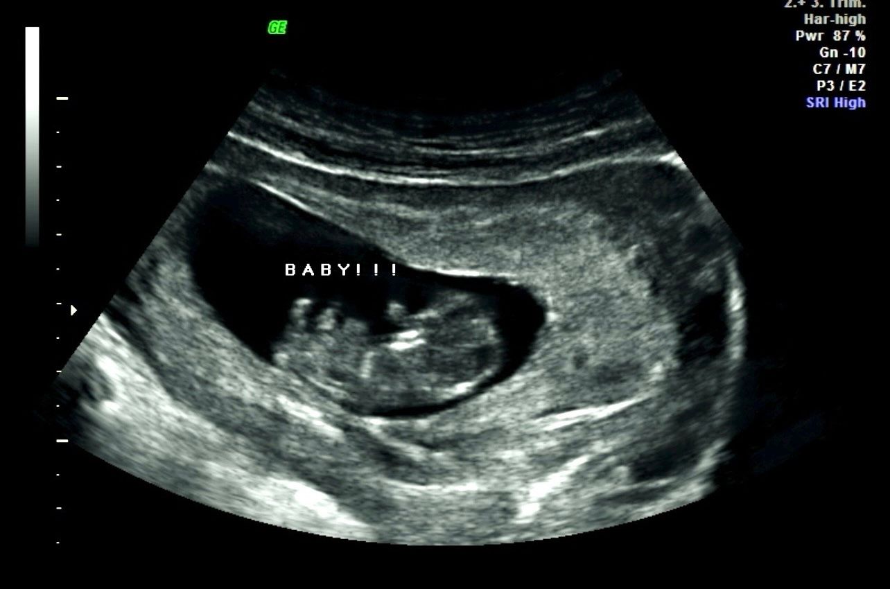 Ultrasound scan showing a fetus in the womb