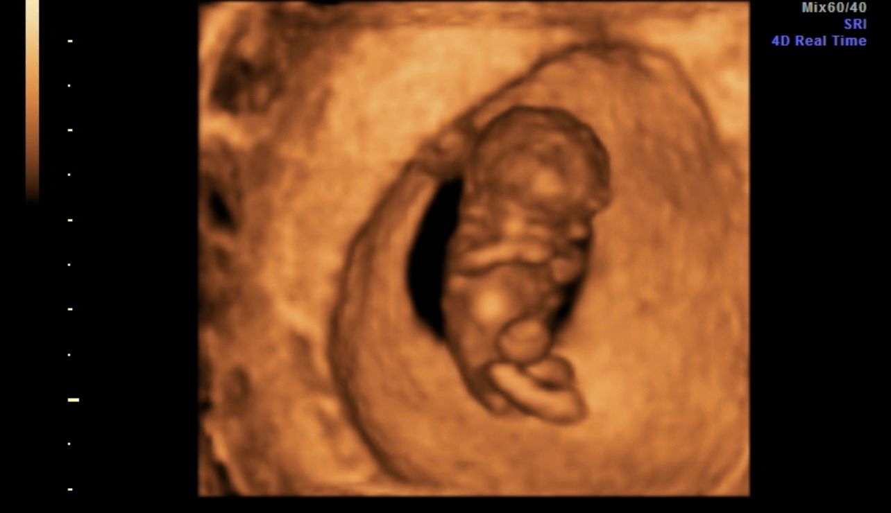 3D ultrasound of a fetus curled inside the womb
