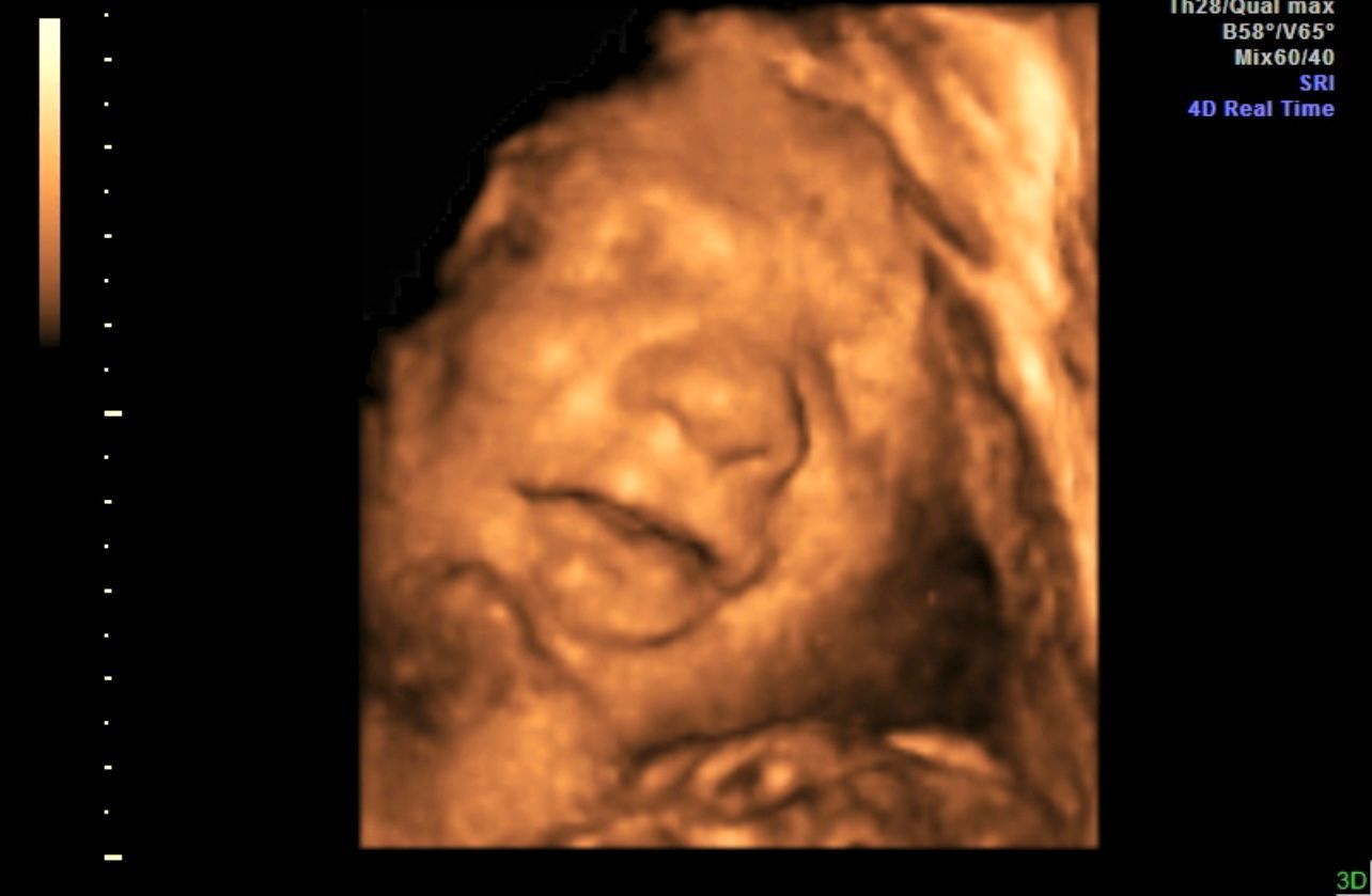 Ultrasound scan showing a fetus curled in the womb, in sepia tones
