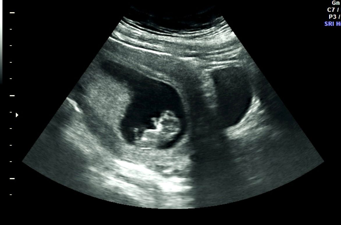 Ultrasound scan showing a fetus in the womb, centered in the black-and-white medical image
