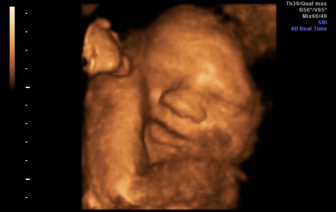 3D ultrasound scan showing a fetus’s face in warm sepia tones