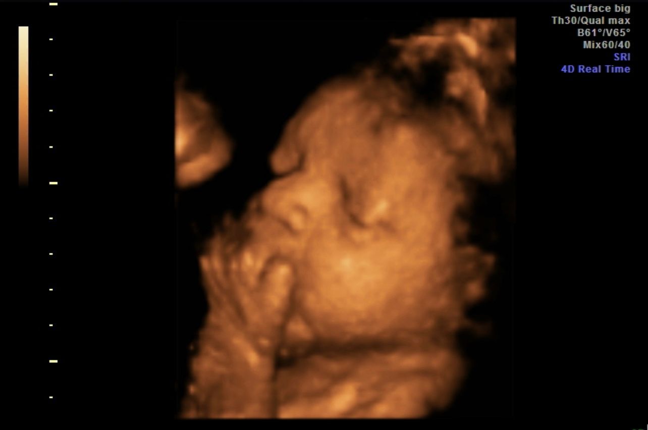 3D ultrasound of a fetus in the womb, shown in sepia tones.