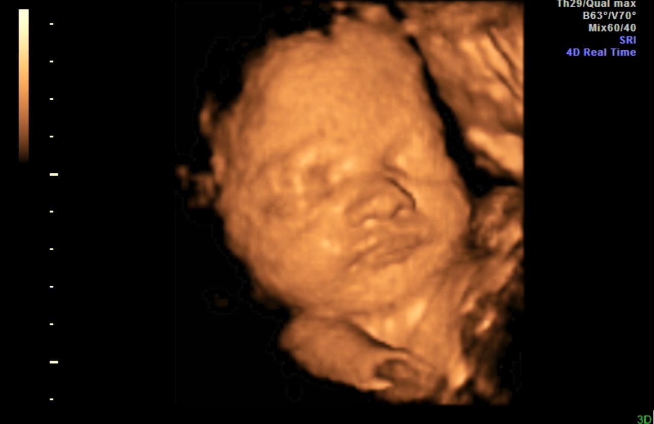 3D ultrasound scan showing a baby's face in warm orange tones against a dark background