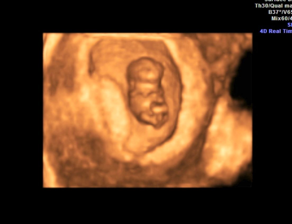 3D ultrasound showing a fetus curled inside the womb, in sepia tones