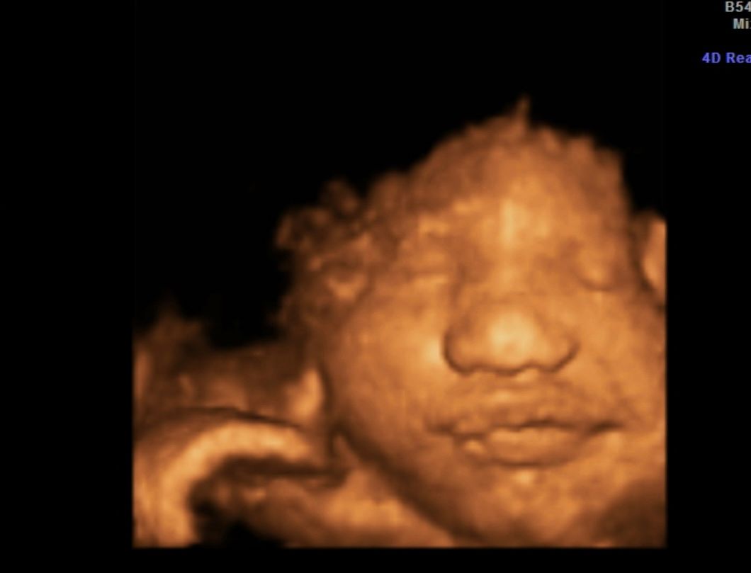 Sepia 3D ultrasound of a sleeping fetus with a hand near the face