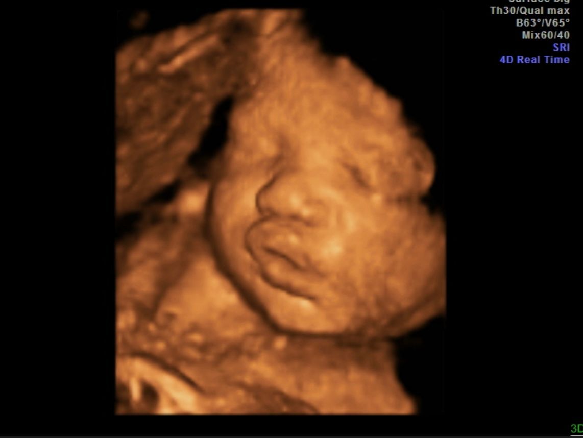 3D ultrasound showing a fetus curled up in the womb