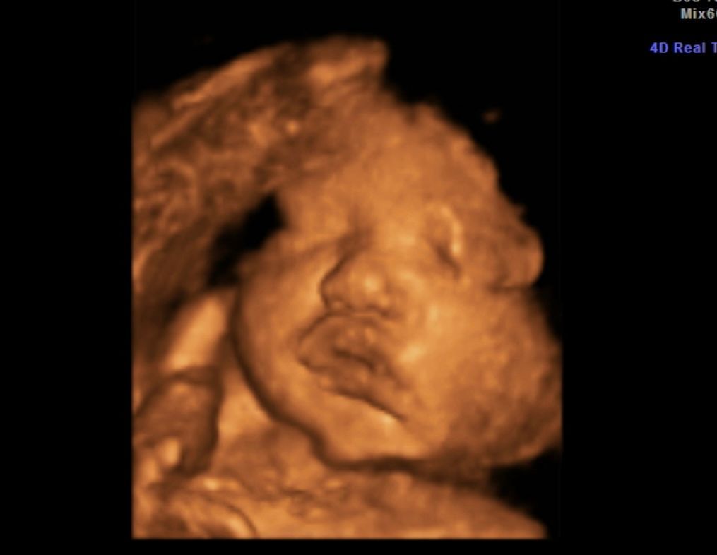 Sepia ultrasound image of a sleeping newborn’s face, with hand resting near the mouth.