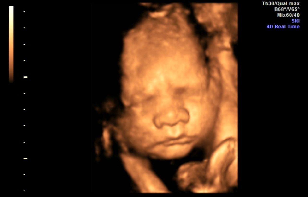3D ultrasound image of a fetus’s face, orange-toned against a black background