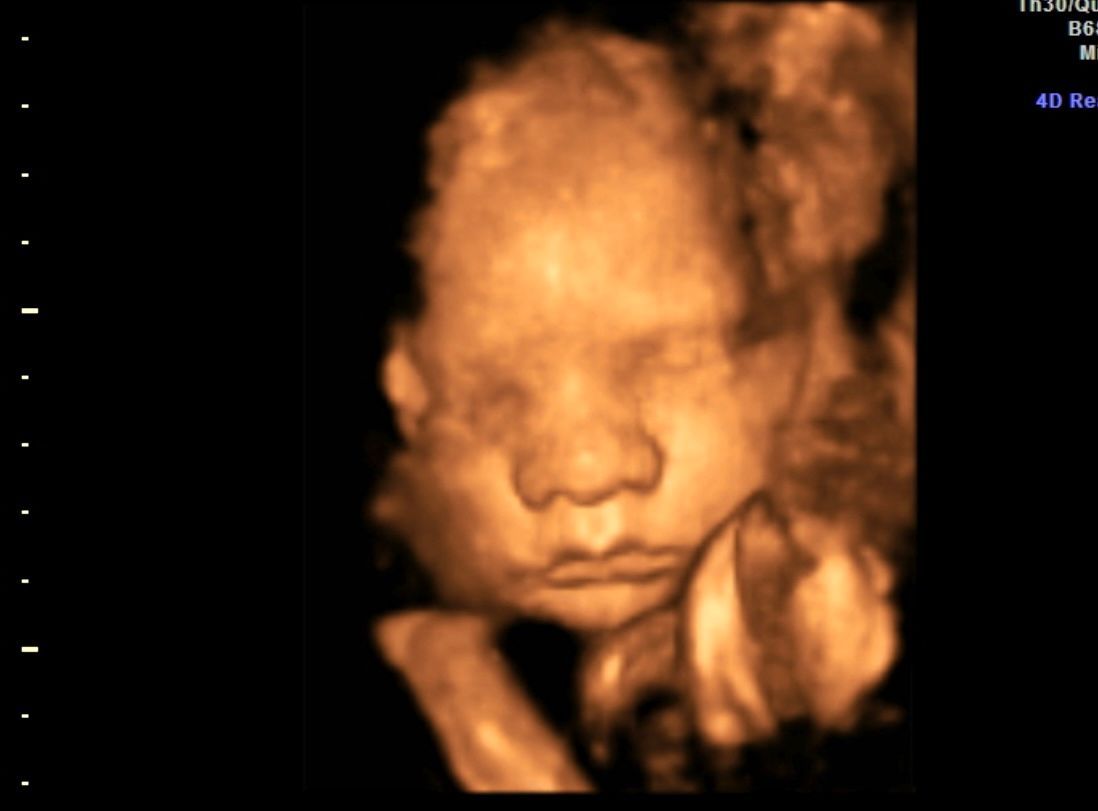 3D ultrasound image of a sleeping fetus with a hand near the face