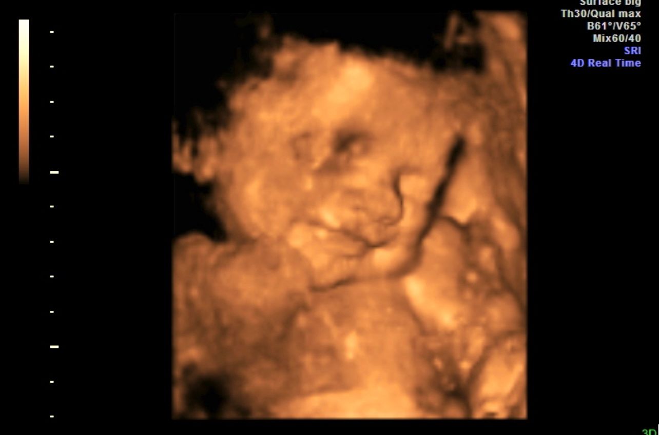 Sepia-toned ultrasound scan showing a fetus in the womb