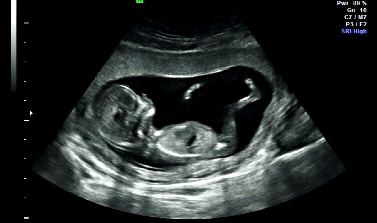 Ultrasound scan showing a fetus in the womb, viewed in black and white.